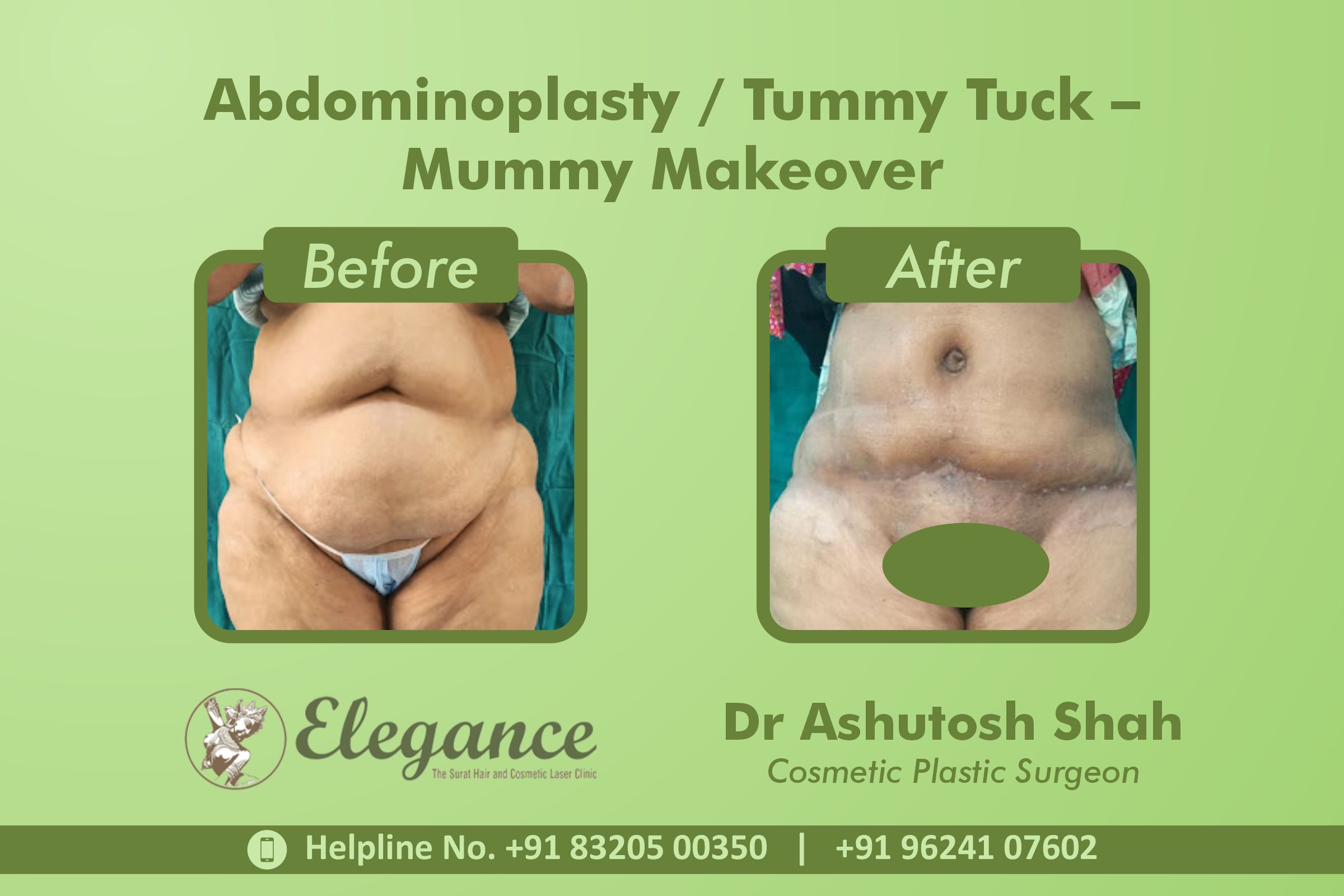 Abdominoplasty, Tummy Tuck, Piplod, Surat