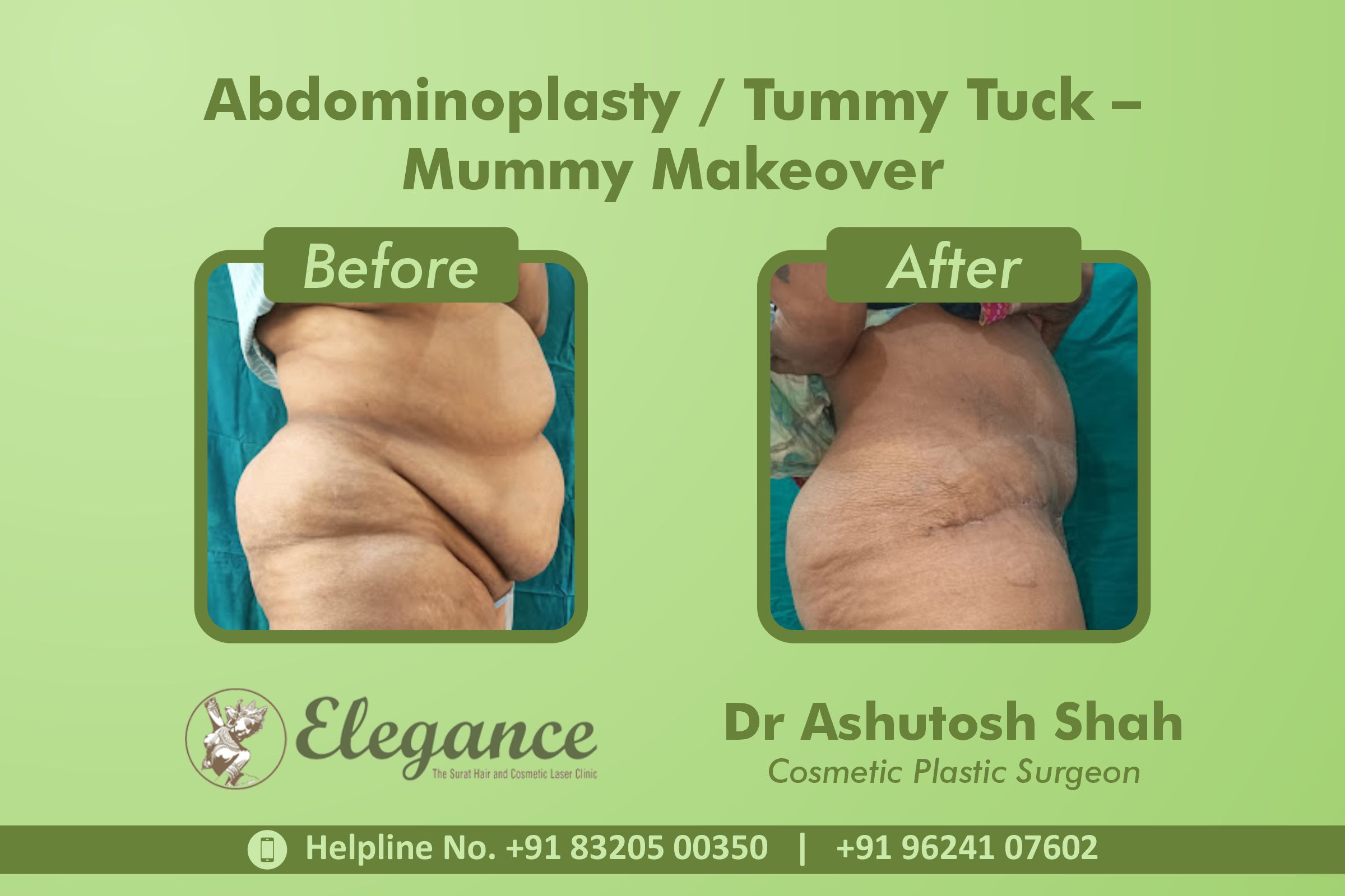 Abdominoplasty, Tummy Tuck, Piplod