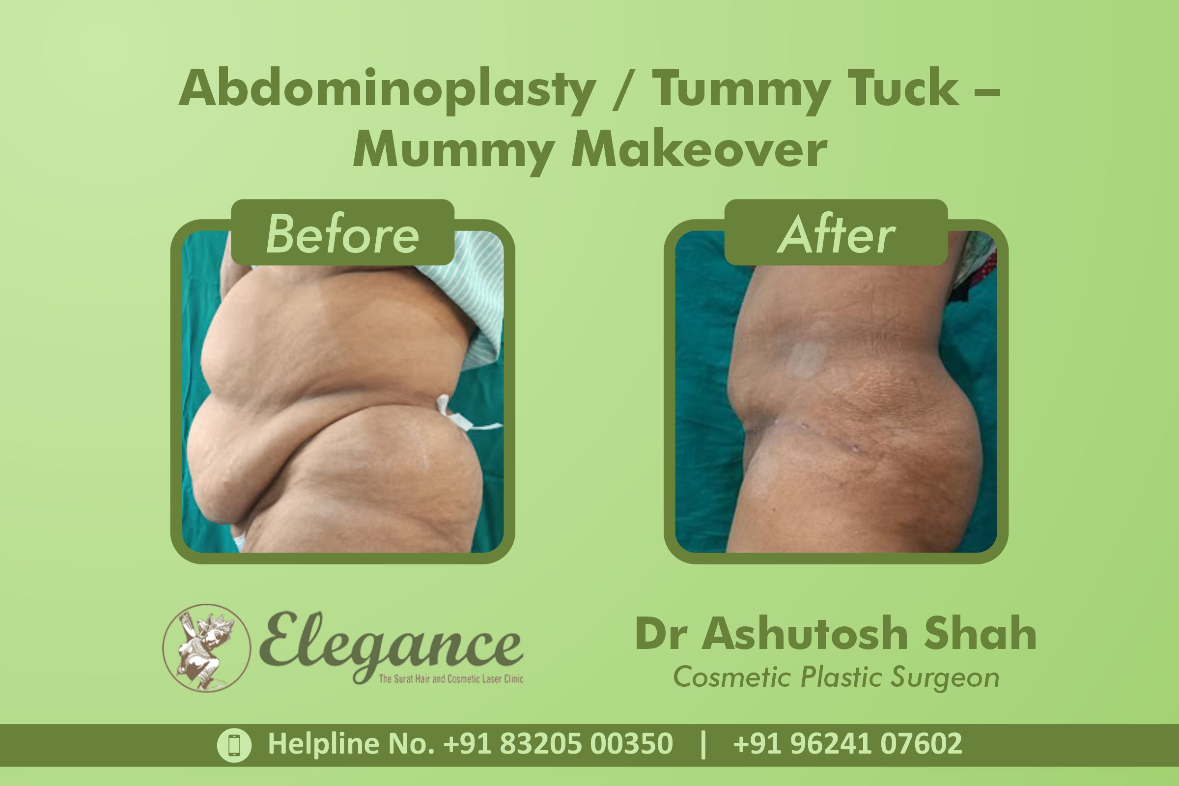 Abdominoplasty, Tummy Tuck Surgery, Piplod, Surat