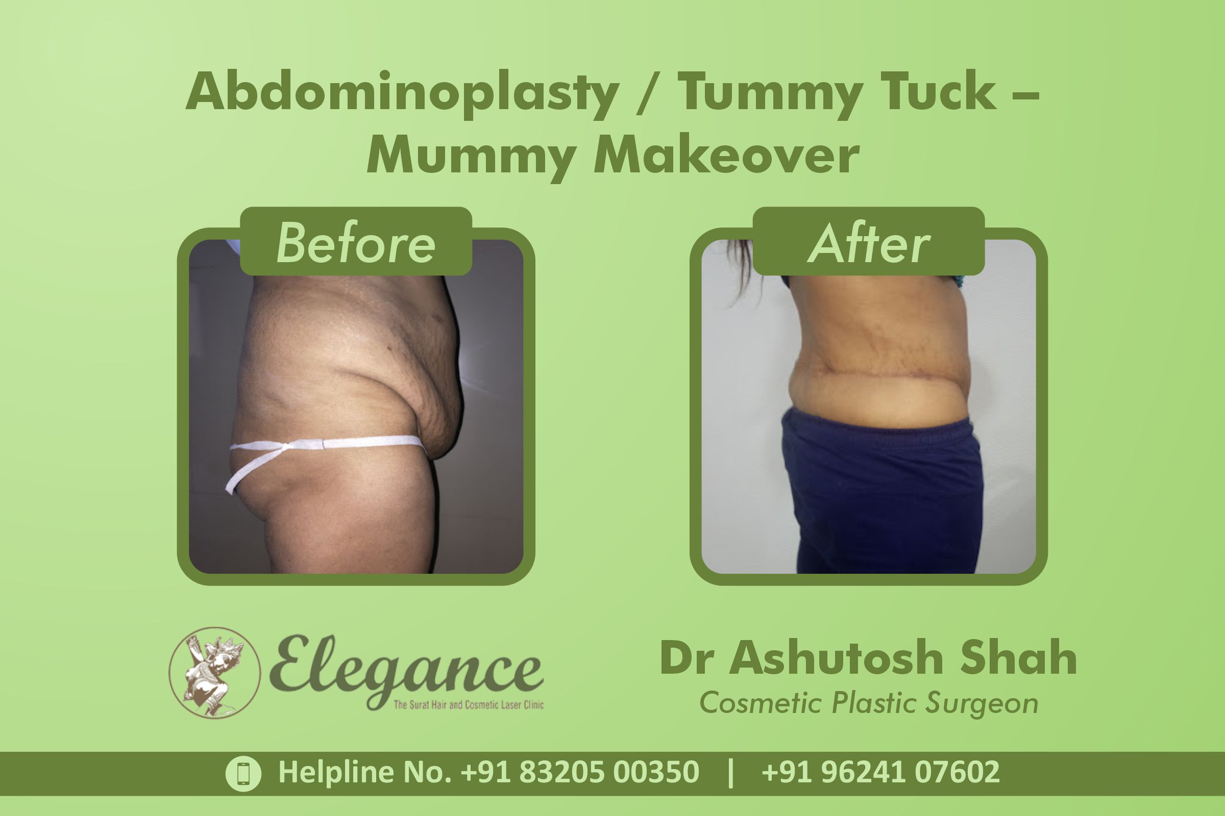 Abdominoplasty, Mummy Makeover Vesu, Surat