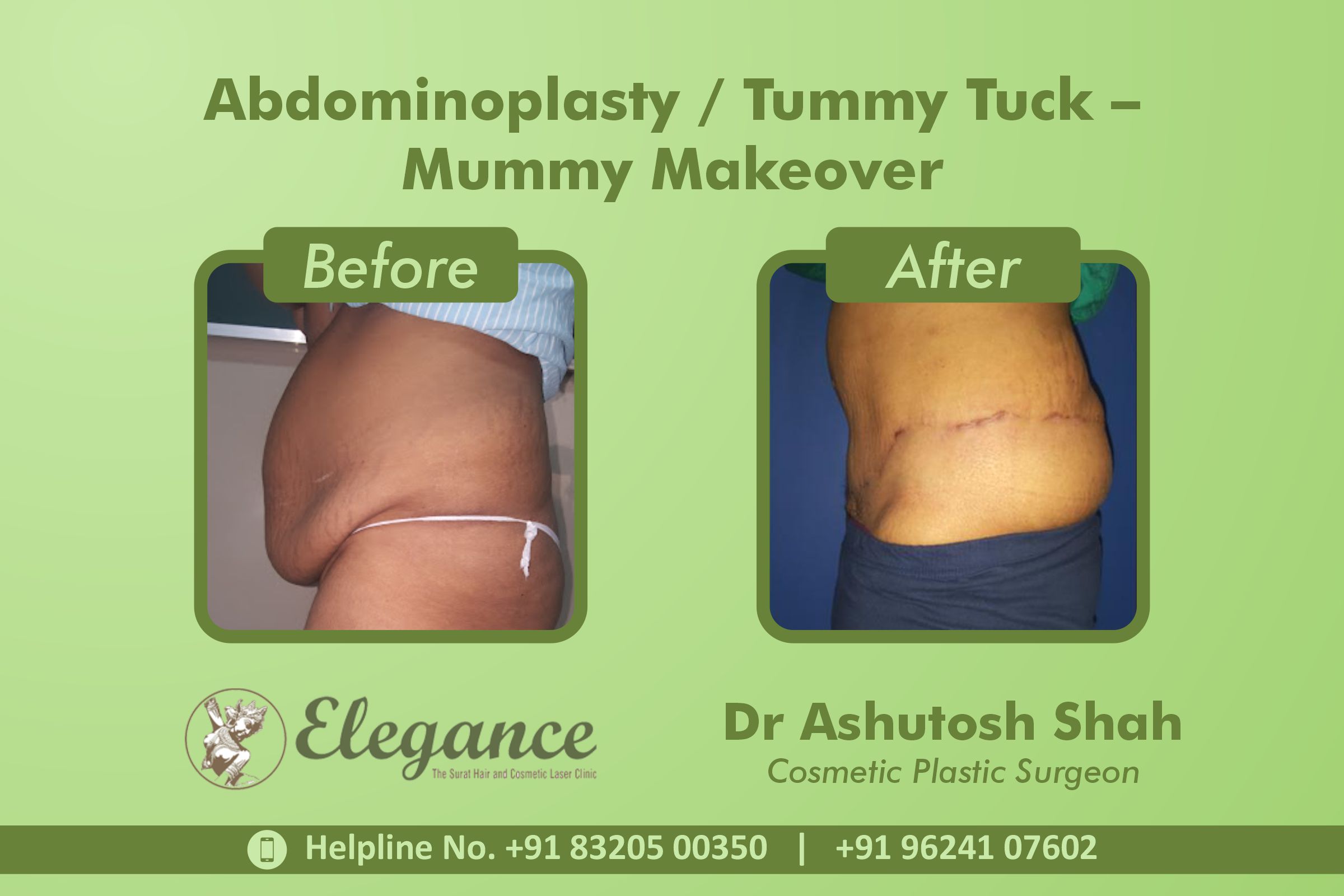 Abdominoplasty, Tummy Tuck, Piplod, Udhna, Surat