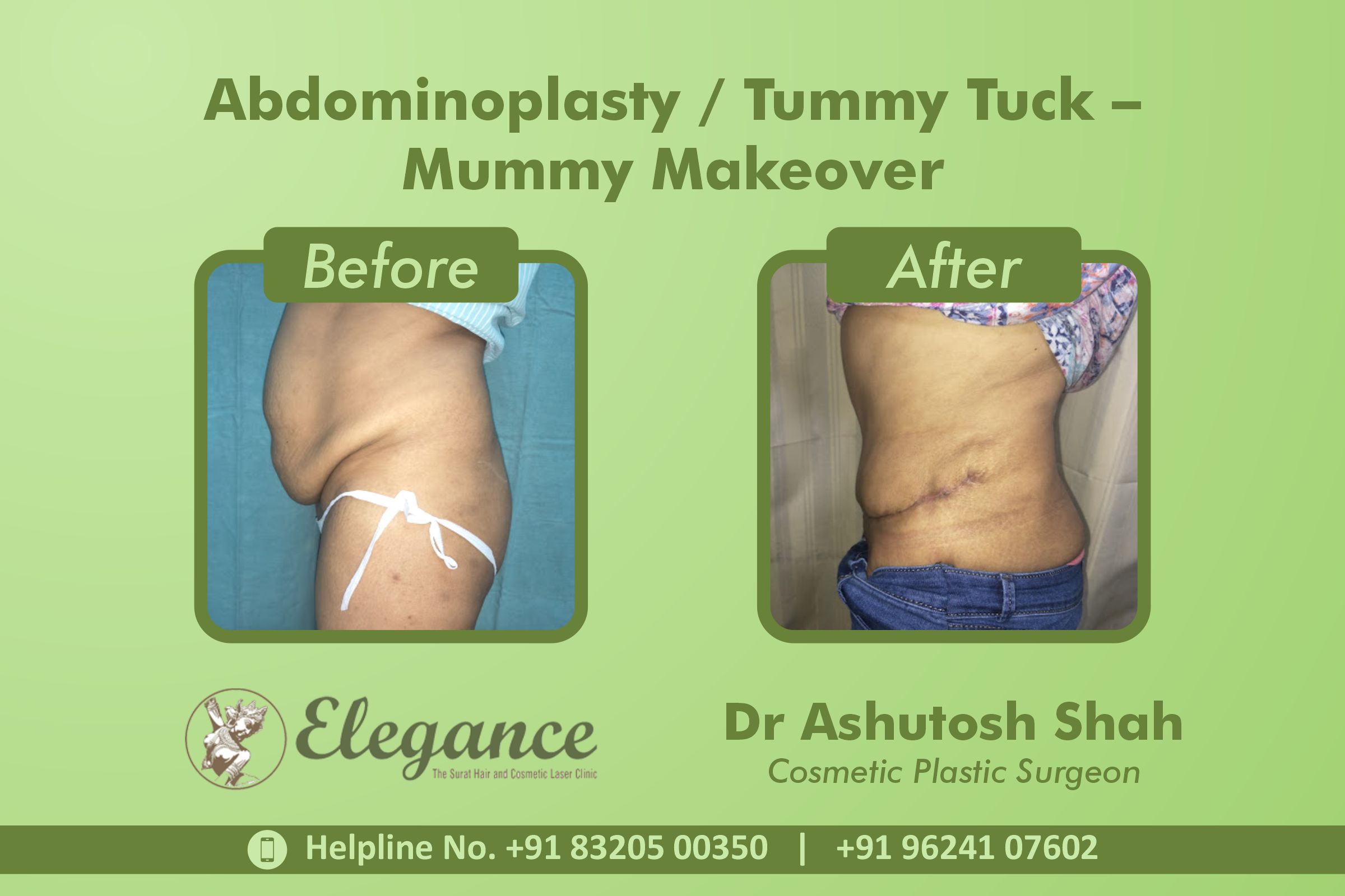 Abdominoplasty, Tummy Tuck Surgery, Mummy Makeover in Udhna, Surat
