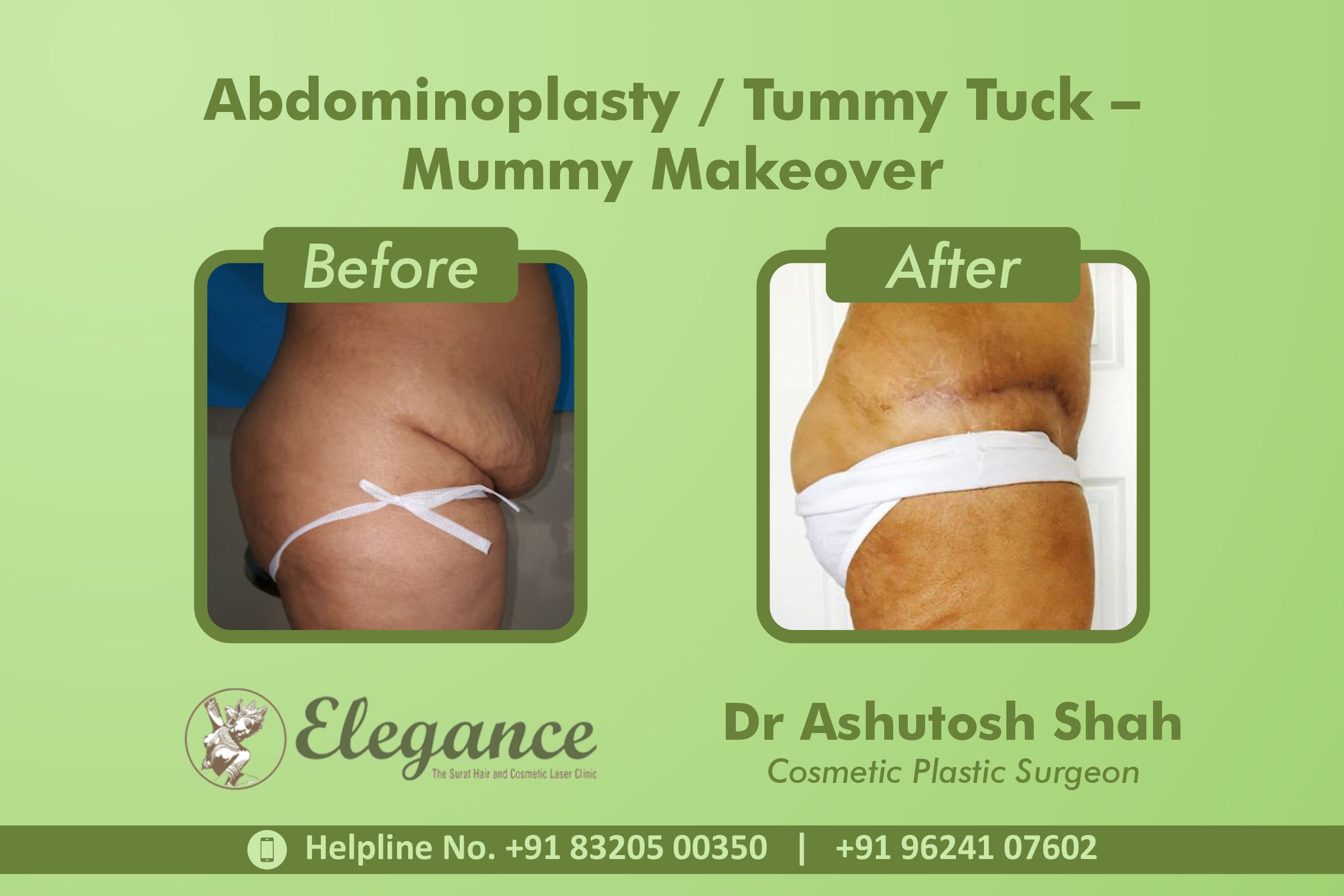 Abdominoplasty, Tummy Tuck Surgery, Mummy Makeover in Vesu, Majuragate, Surat
