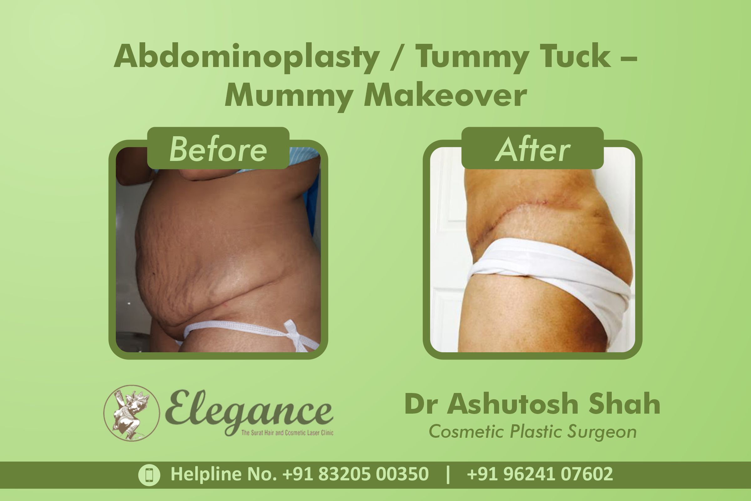 Abdominoplasty, Tummy Tuck Surgery, Mummy Makeover in Vesu, Rander, Surat