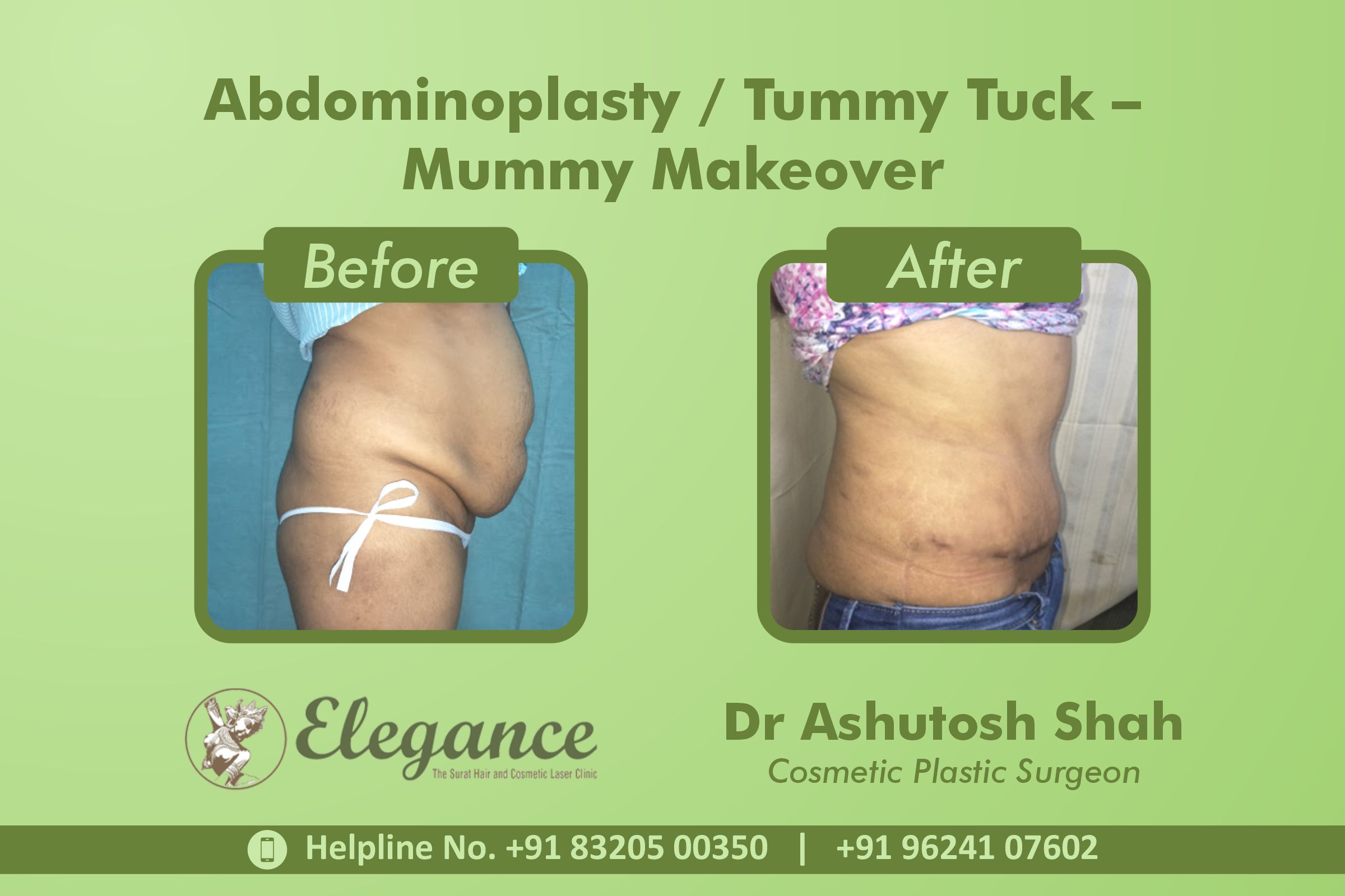 Abdominoplasty, Tummy Tuck Surgery, Pal, Vesu, Surat