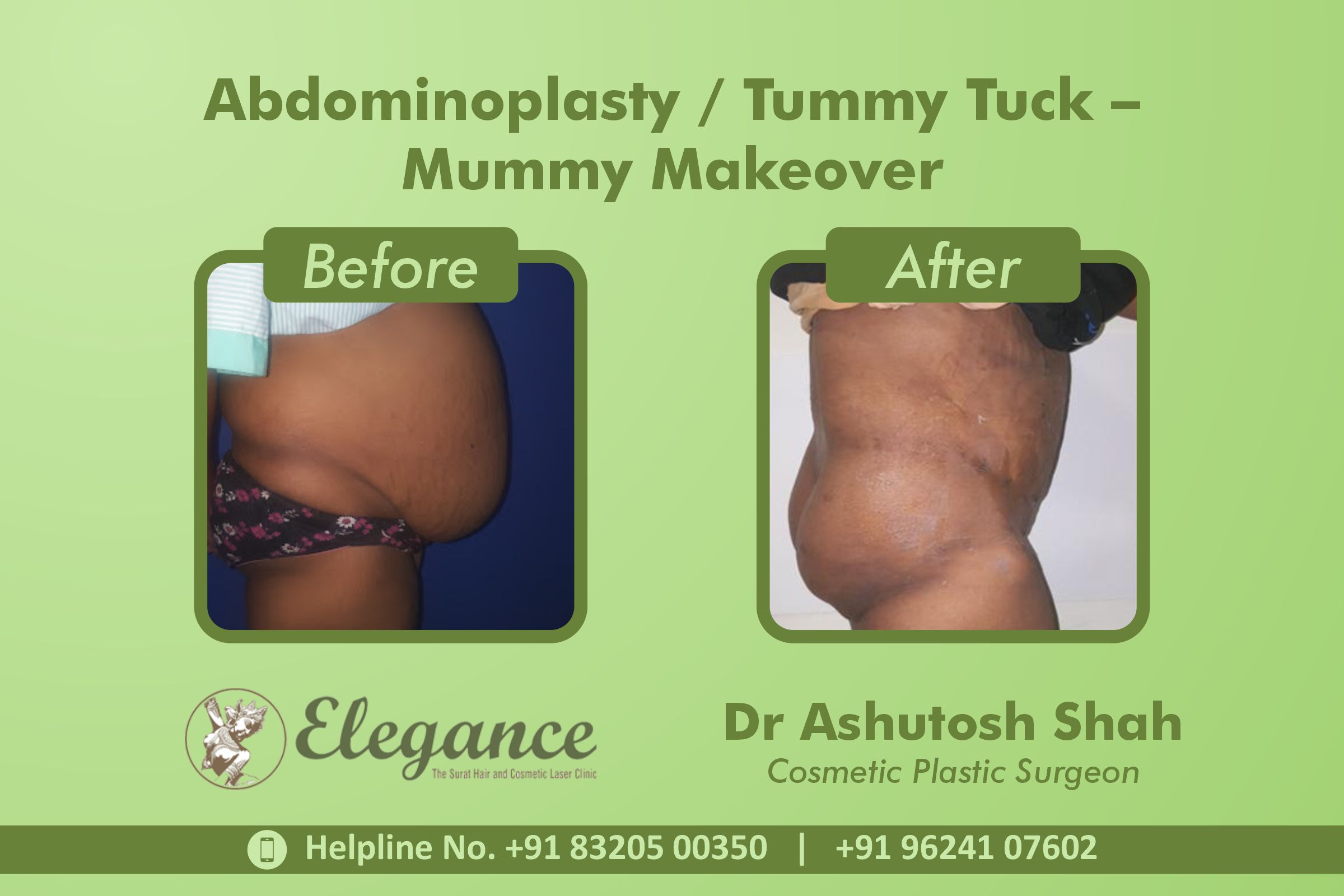 Abdominoplasty, TummyTuck- Mummy Makeover, Vesu, Piplod, Surat