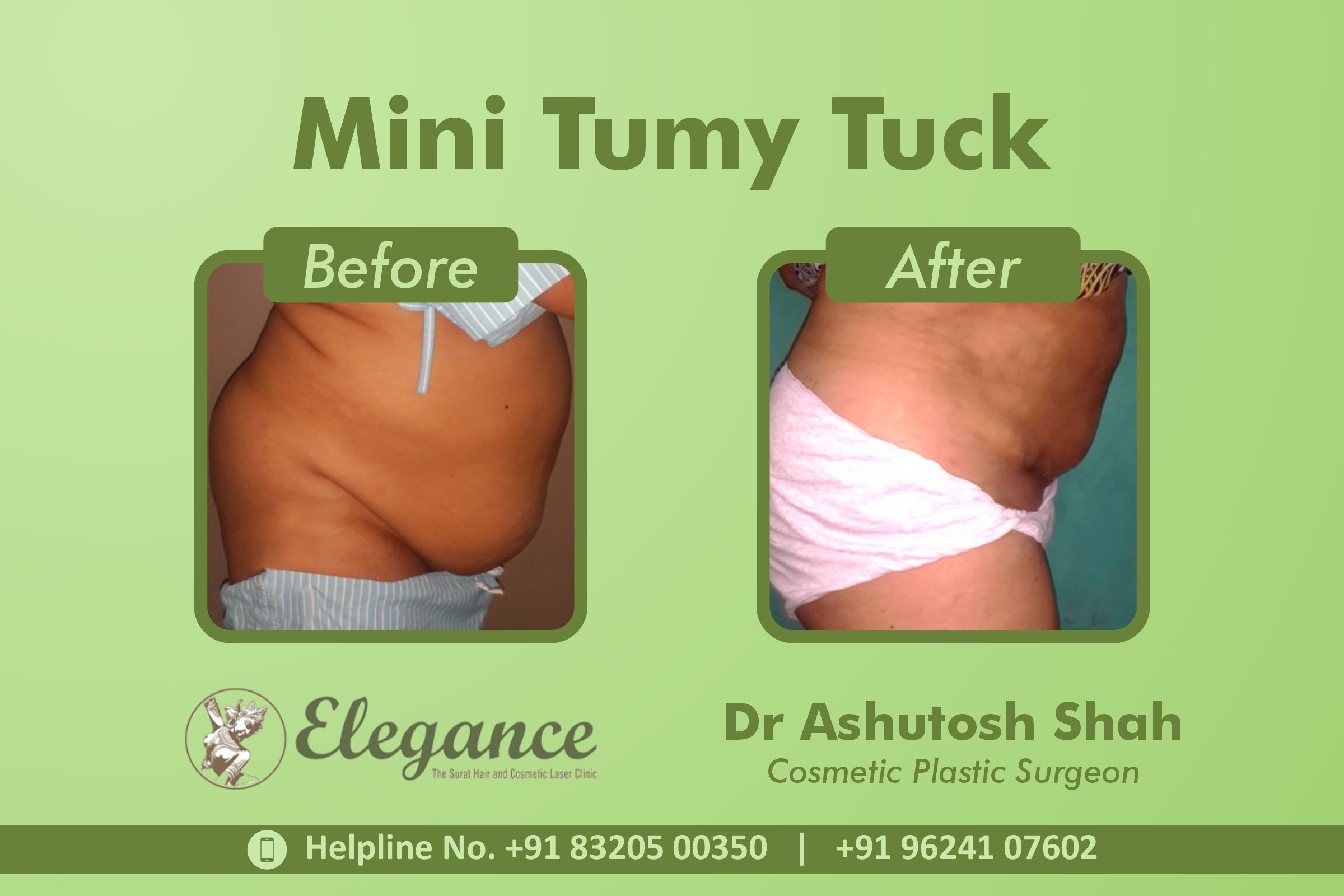 Tummy Tuck Surgery Bharuch Gujarat India