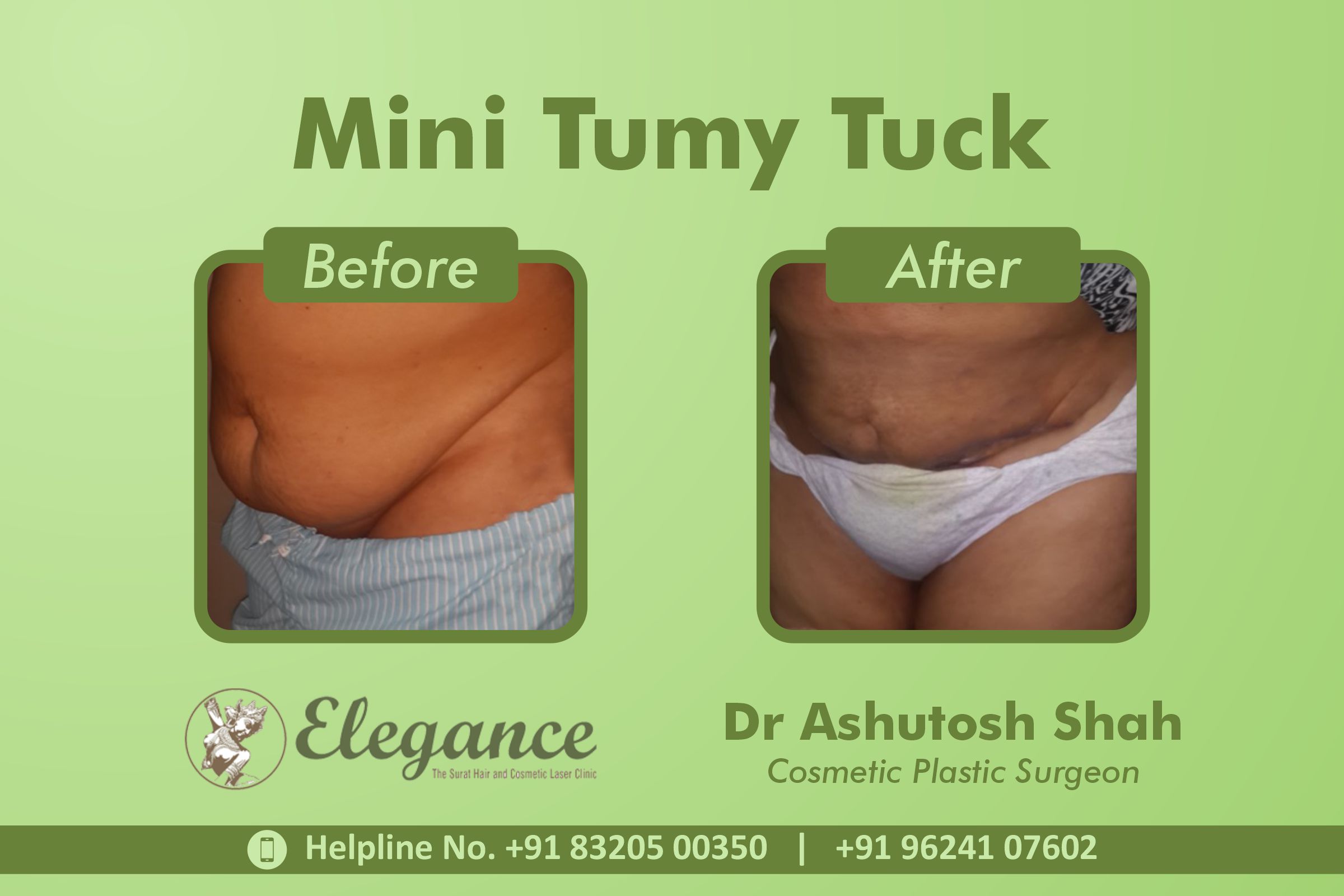 Mini Tummy Tuck Surgery Vadodara, Gujarat