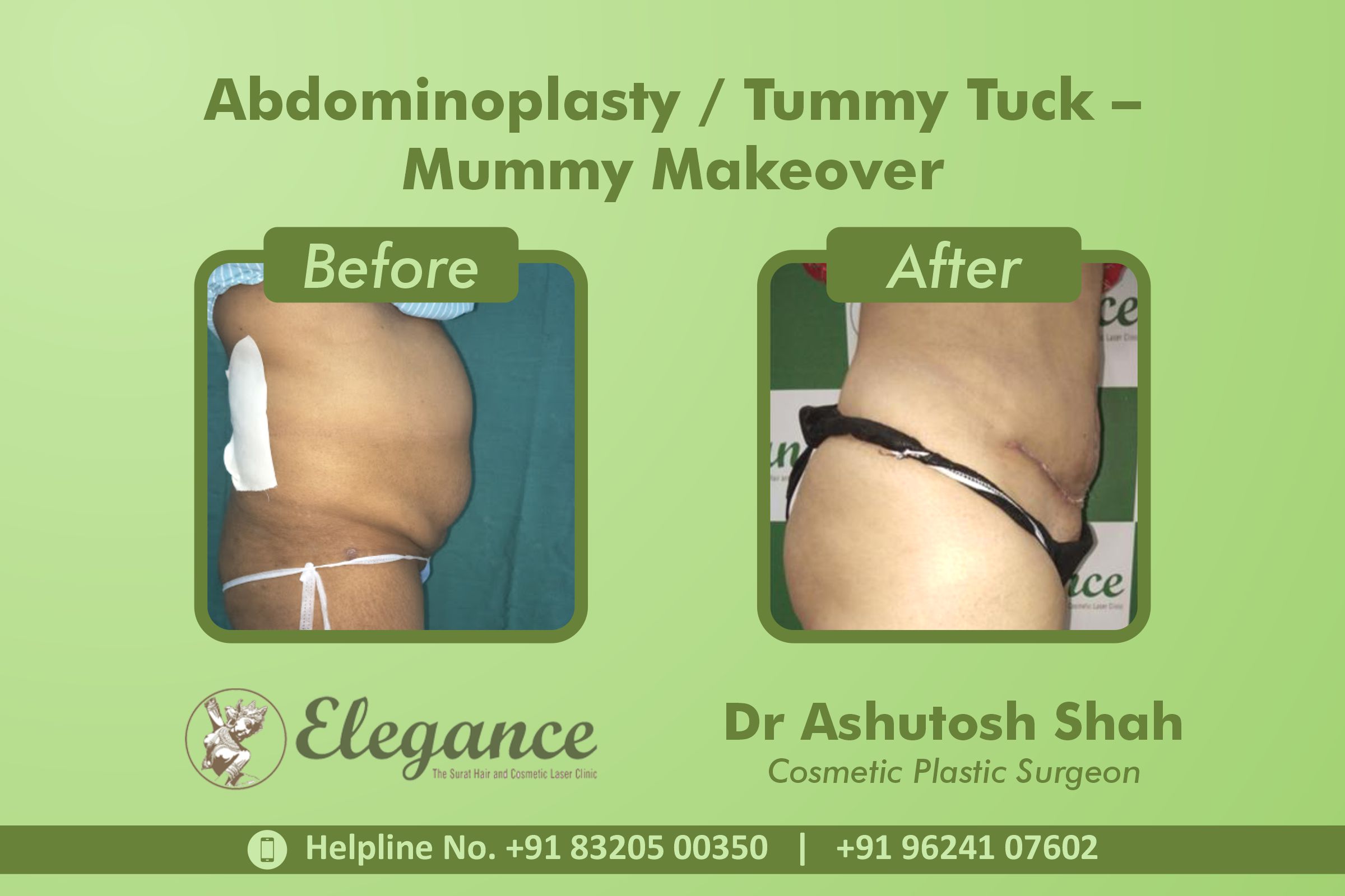 Abdominoplasty, Tummy Tuck Surgery, Mummy Makeover in Adajan, Surat