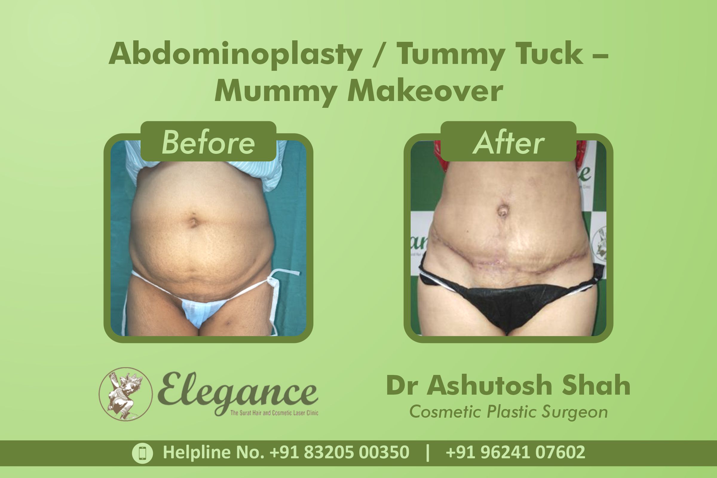 Abdominoplasty, Tummy Tuck Surgery, Mummy Makeover in Adajan