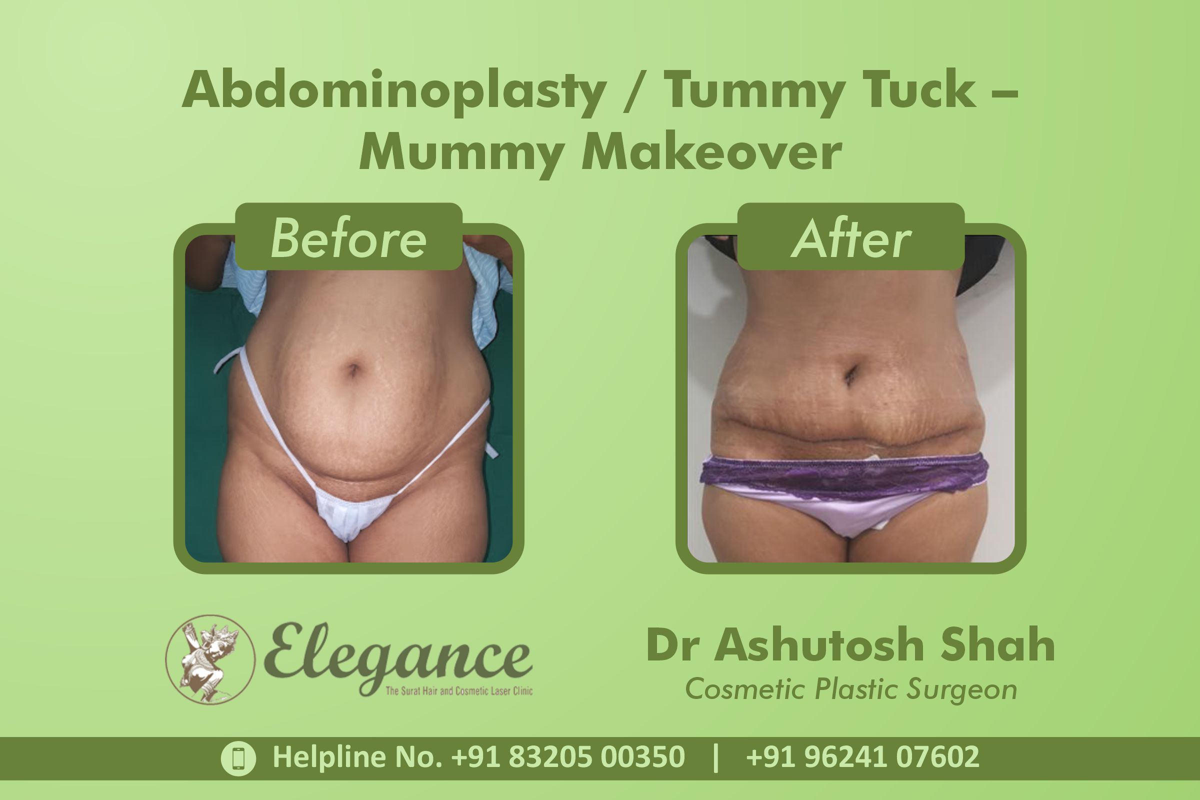 Abdominoplasty, Tummy Tuck Surgery, Mummy Makeover in Athwagate, Surat