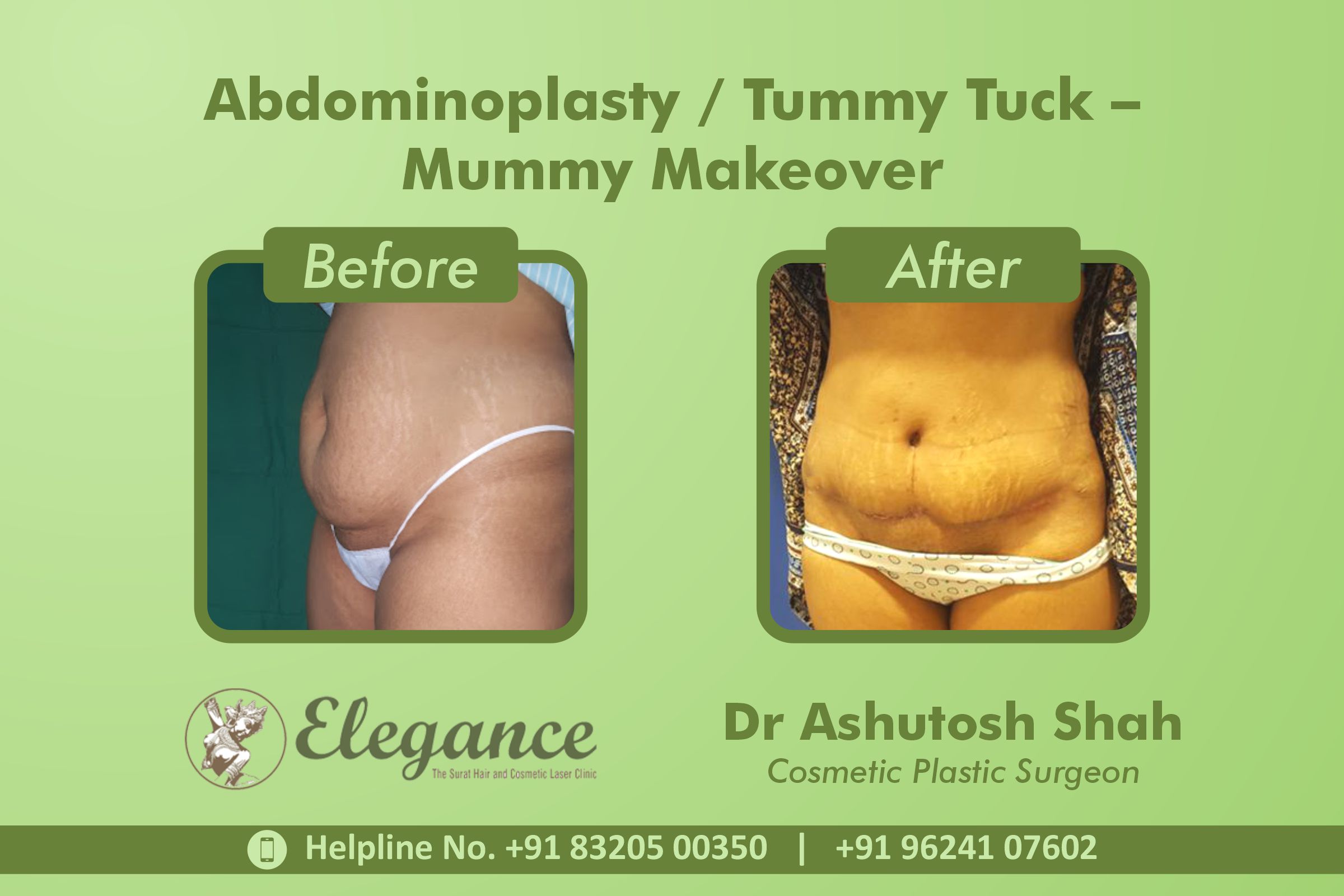 Abdominoplasty, Tummy Tuck Surgery, Mummy Makeover in Athwagate