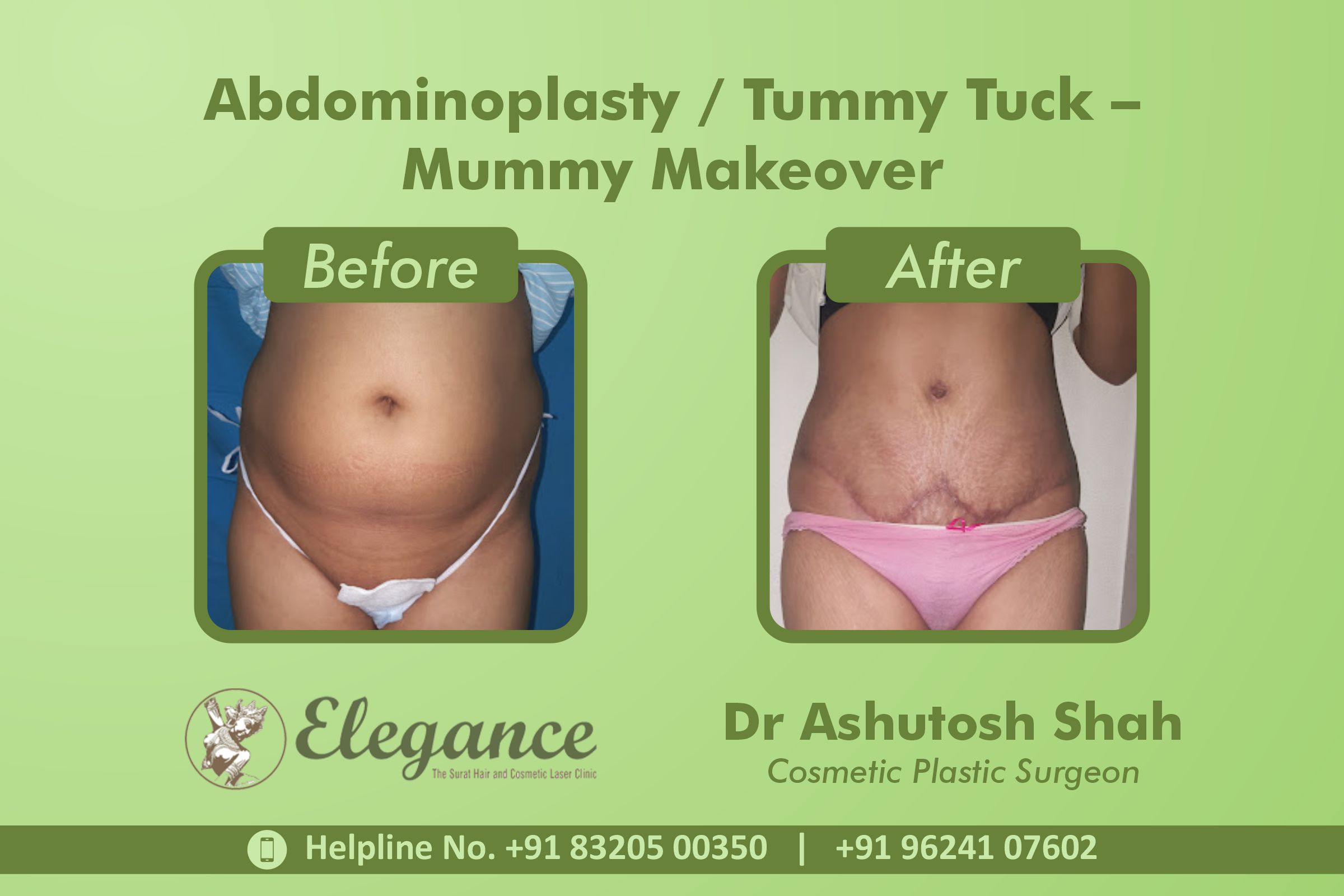 Abdominoplasty, Tummy Tuck Surgery, Mummy Makeover in Majuragate, Surat