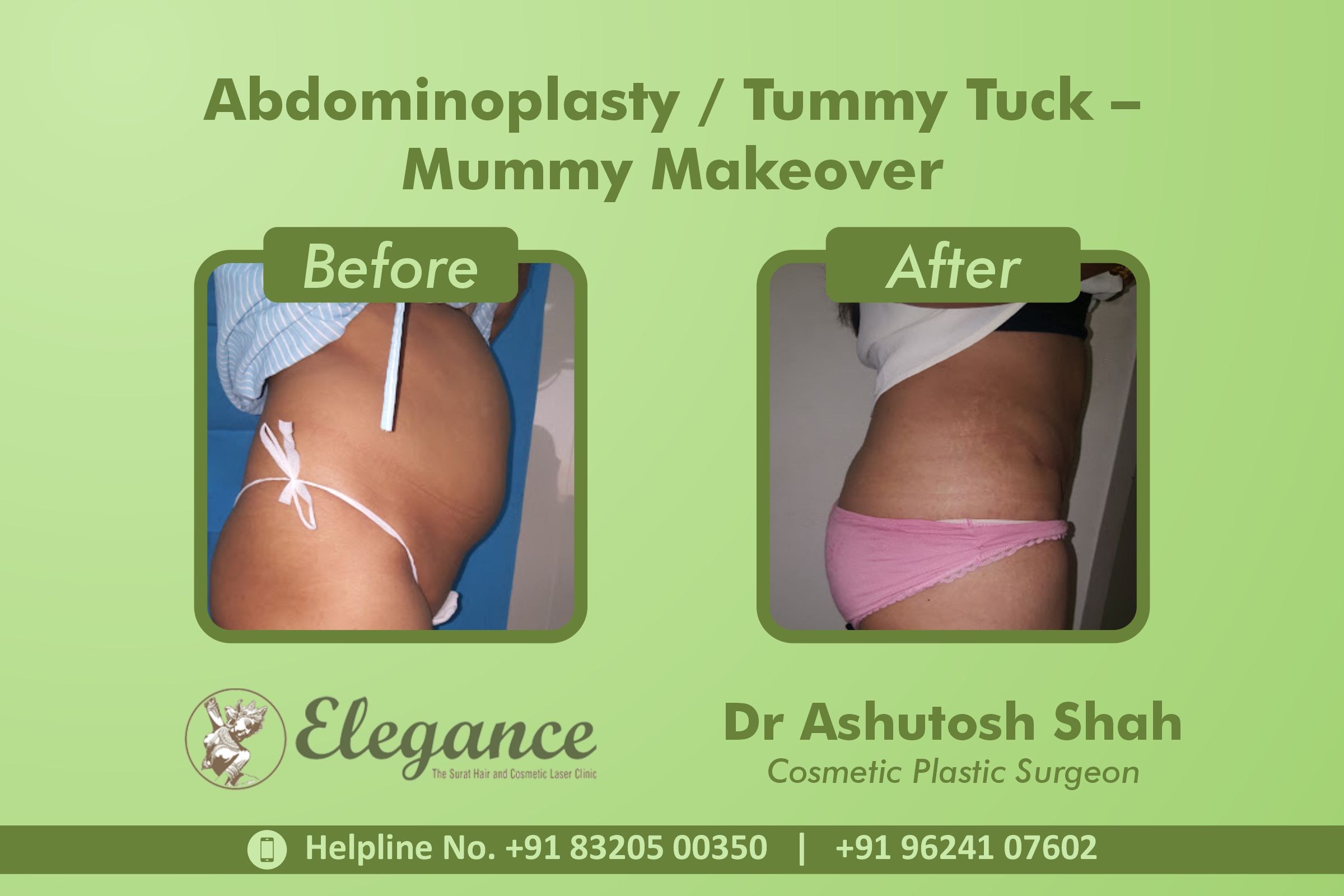 Abdominoplasty, Tummy Tuck Surgery, Mummy Makeover in Majuragate