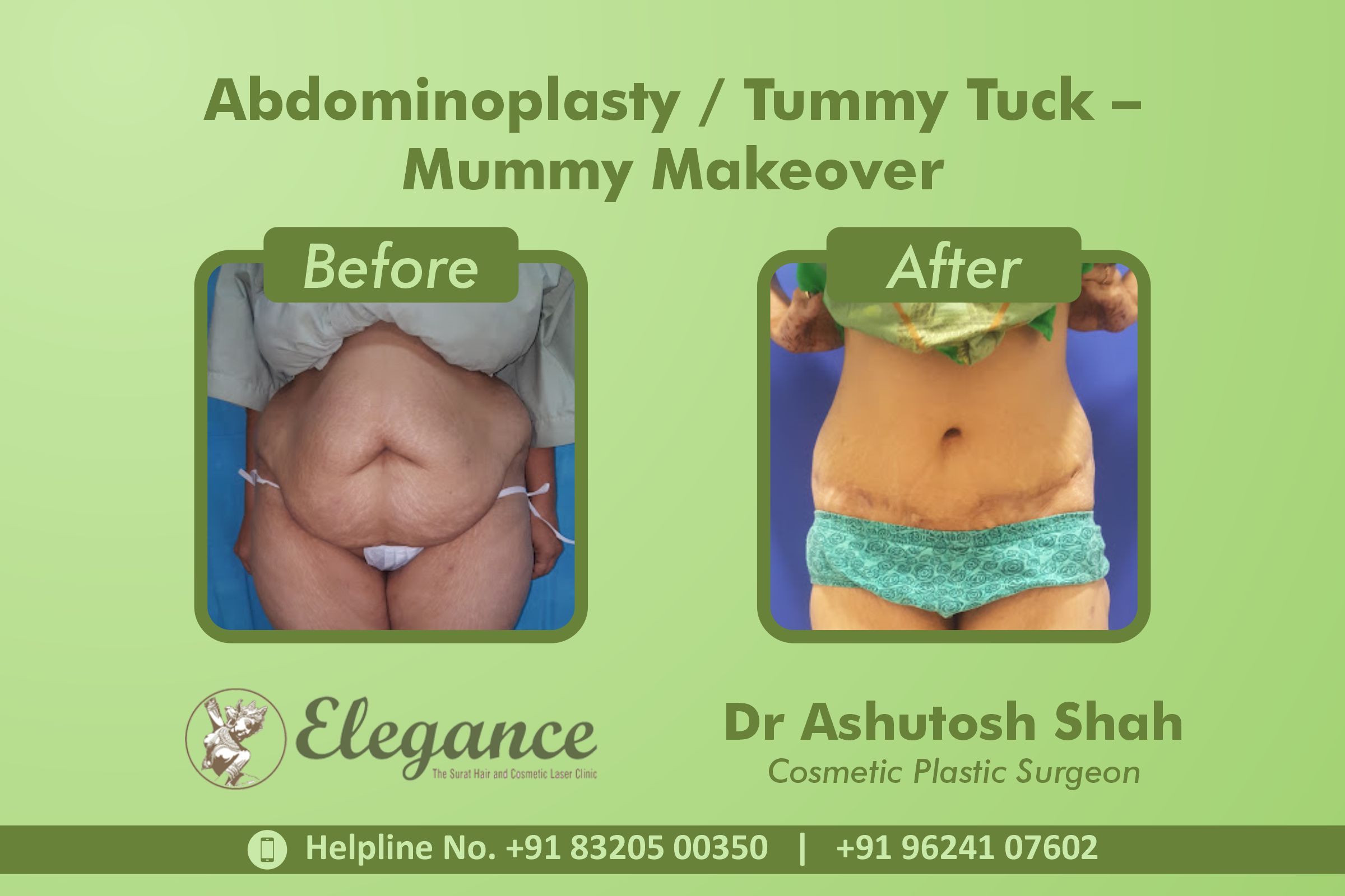 Abdominoplasty, Tummy Tuck Surgery, Mummy Makeover in Morabhagal, Surat