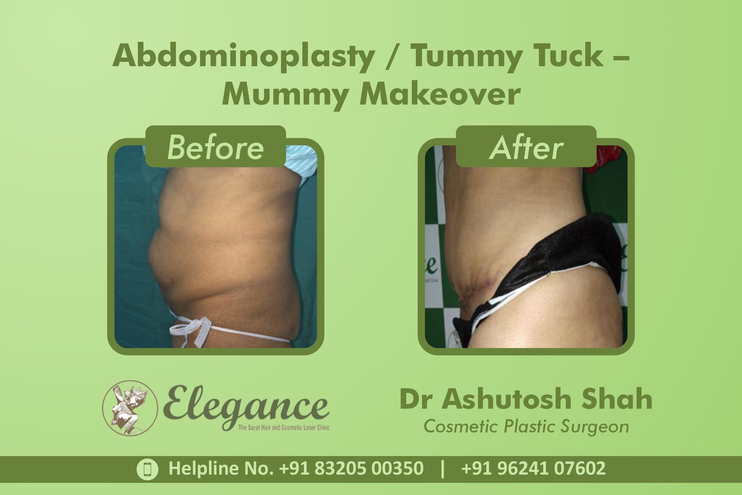 Abdominoplasty, Tummy Tuck Surgery, Mummy Makeover in Pal, Surat