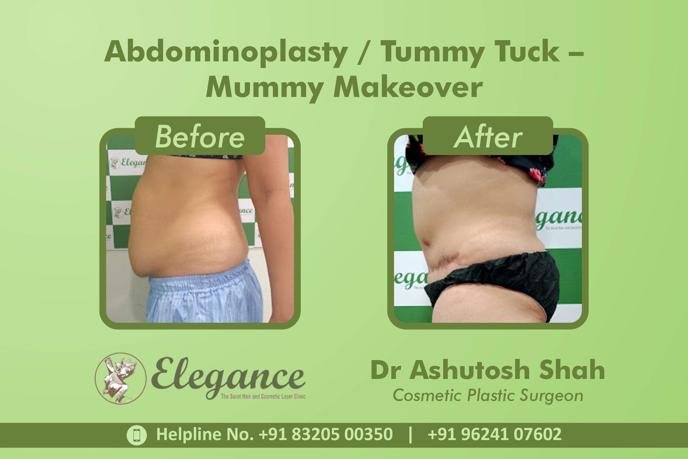 Abdominoplasty, Tummy Tuck Surgery, Mummy Makeover in Piplod, Surat