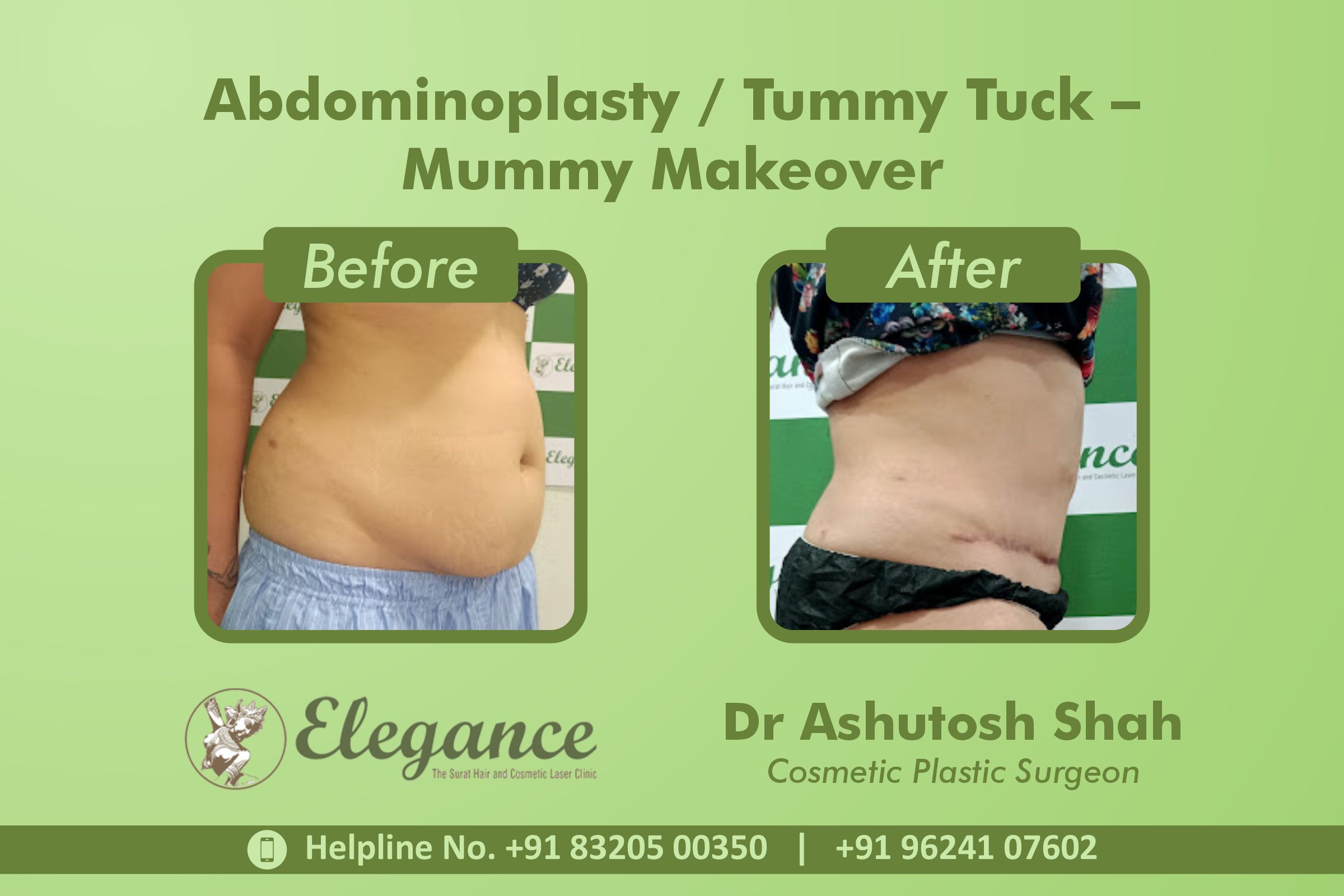 Abdominoplasty, Tummy Tuck Surgery, Mummy Makeover in Piplod
