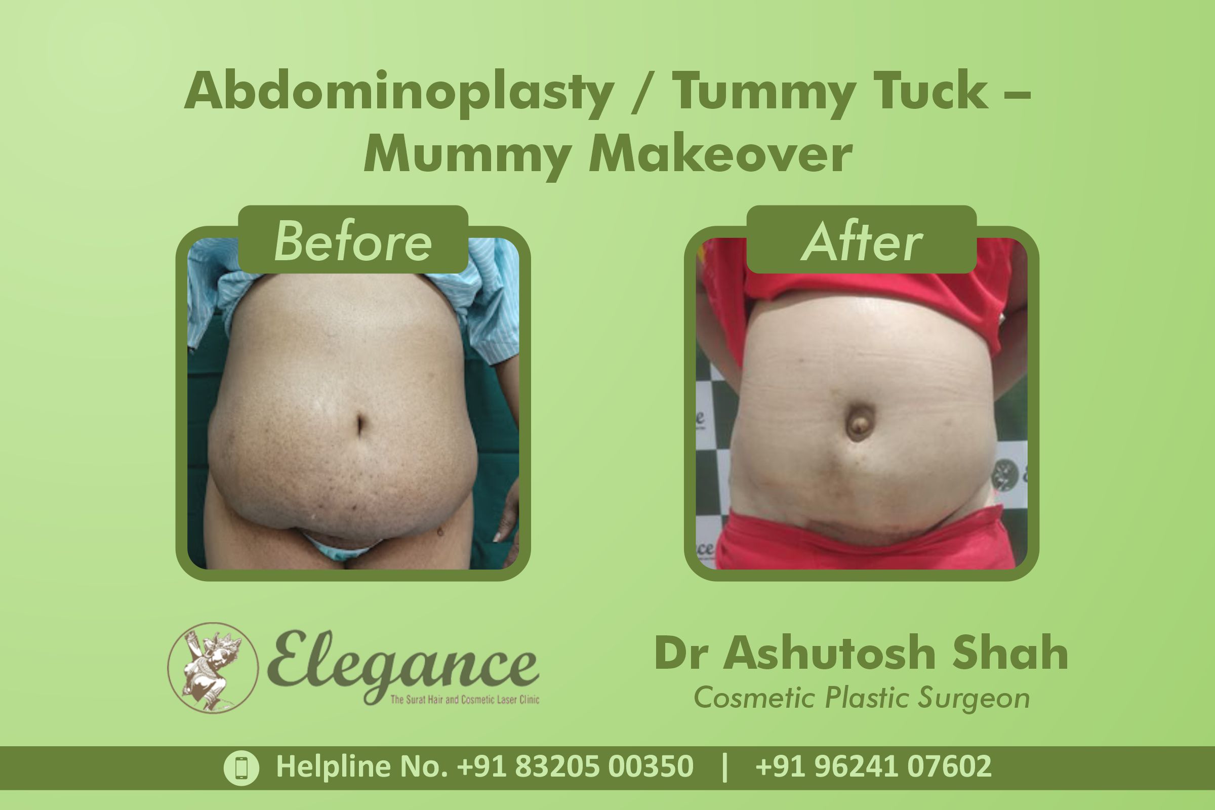 Abdominoplasty, Tummy Tuck Surgery, Mummy Makeover in Rander