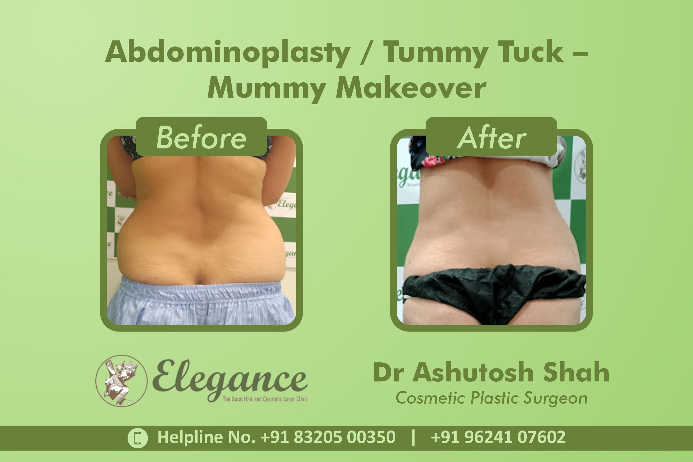 Abdominoplasty, Tummy Tuck Surgery, Mummy Makeover in Udhna