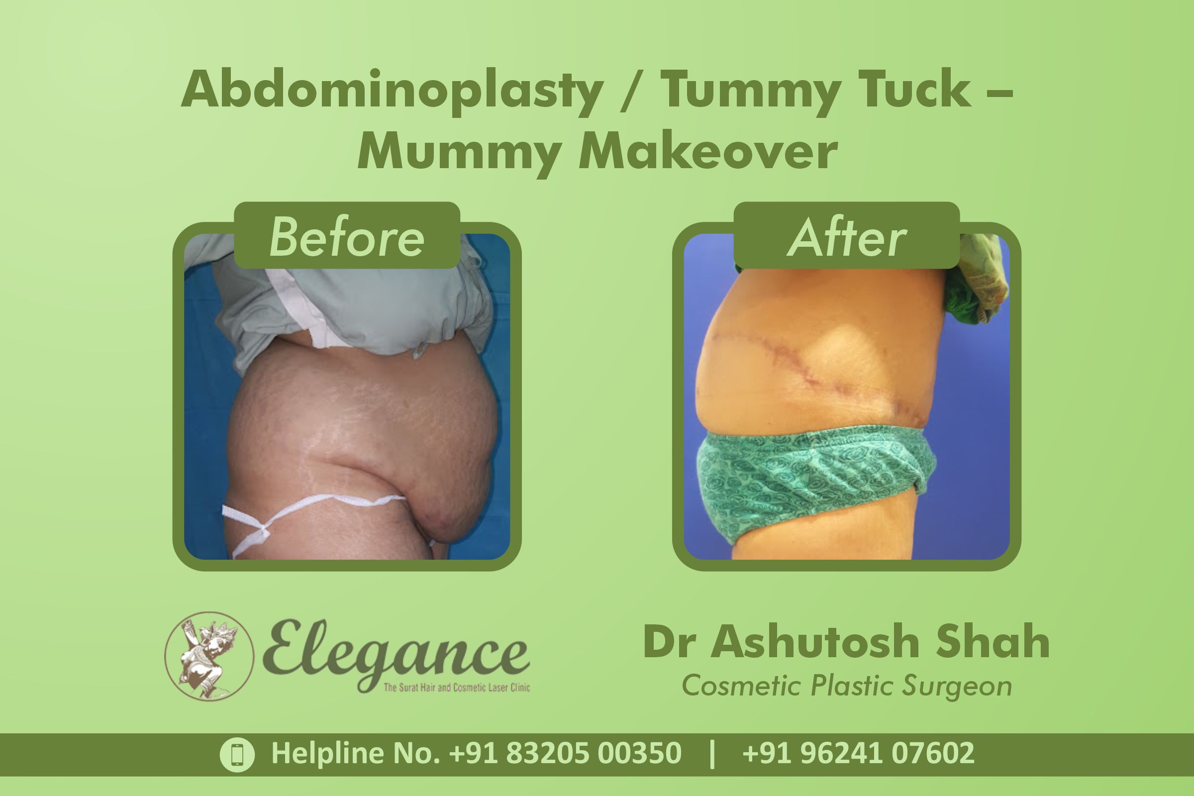 Abdominoplasty, Tummy Tuck Surgery, Mummy Makeover in Vesu, Majuragate