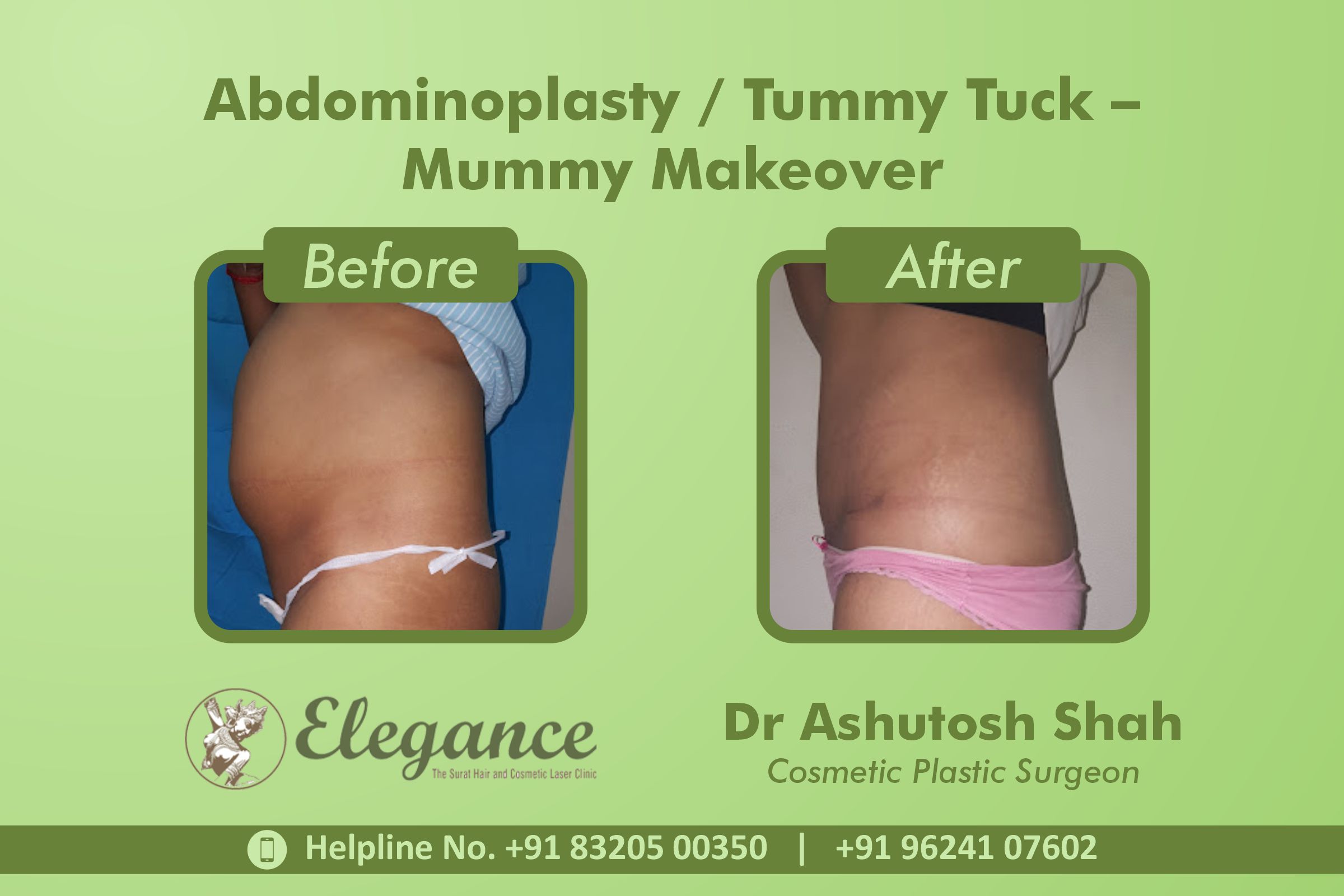 Abdominoplasty, Tummy Tuck Surgery, Mummy Makeover in Vesu