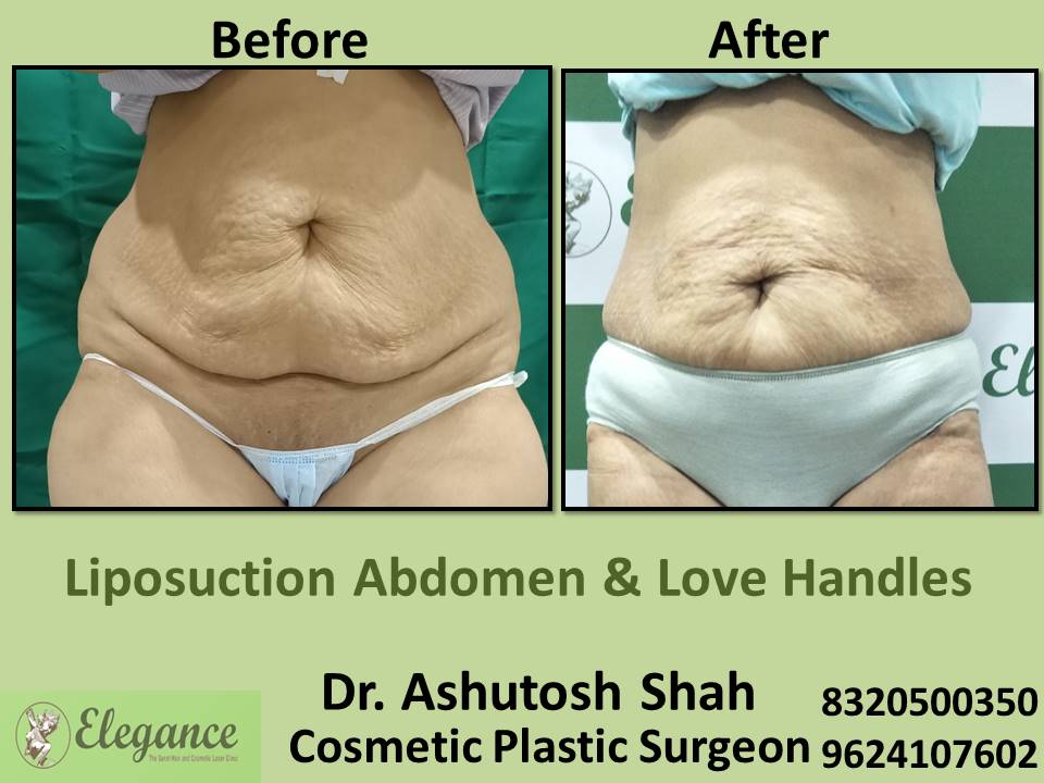 Liposuction Abdomen And Love Handles, Cosmetic Surgery, Fat Removal, Nanpura, Athwa, Adajan, Surat, Gujarat.