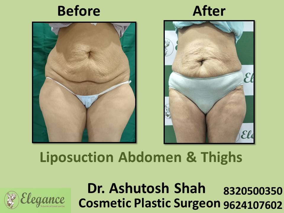 Liposuction Abdomen And Love Handles, Fat Removal Surgery, Dang, Pandesara, Dang, Valsad, Surat, Gujarat.