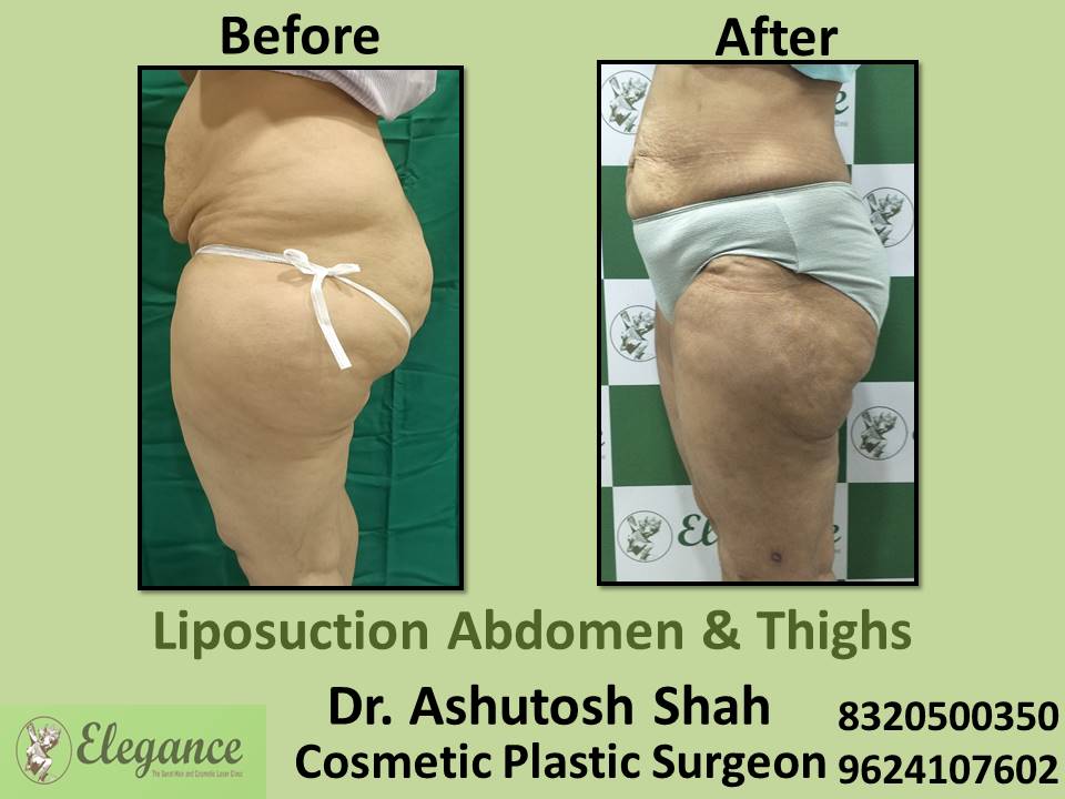 Liposuction Abdomen And Love Handles, Tummy Tuck Clinic, Dindoli, Pandesara, Udhna, Surat, Gujarat