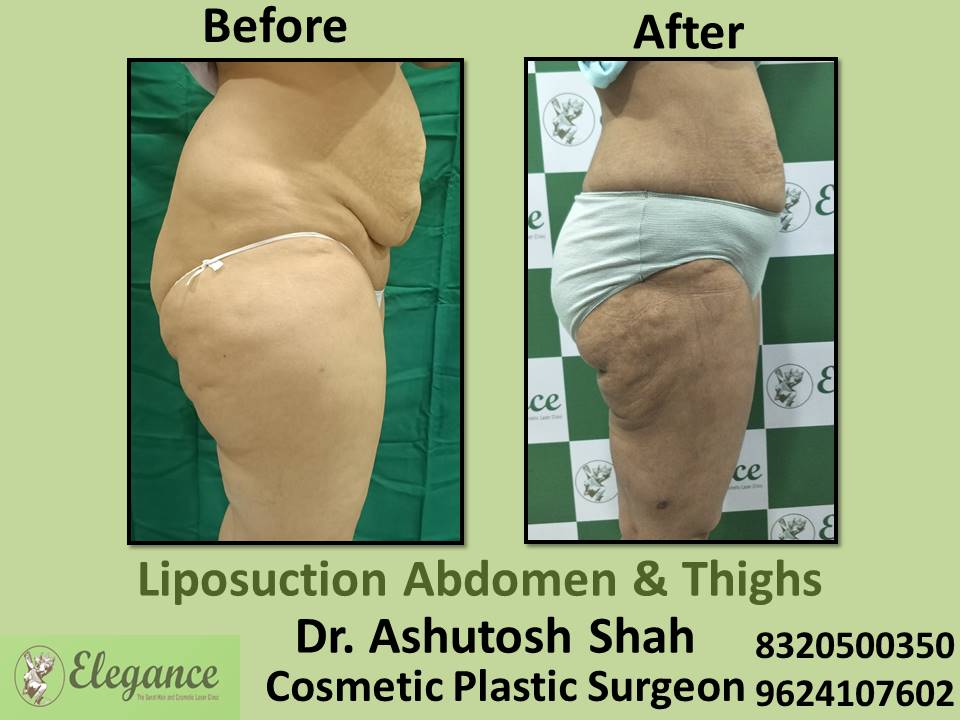 Liposuction Abdomen And Love Handles, Tummy Tuck Removing, Dang, Tapi, Ahemdabad, Surat, Gujarat.