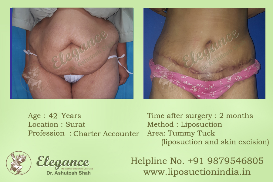 Best Liposuction in Surat, Gujarat, india