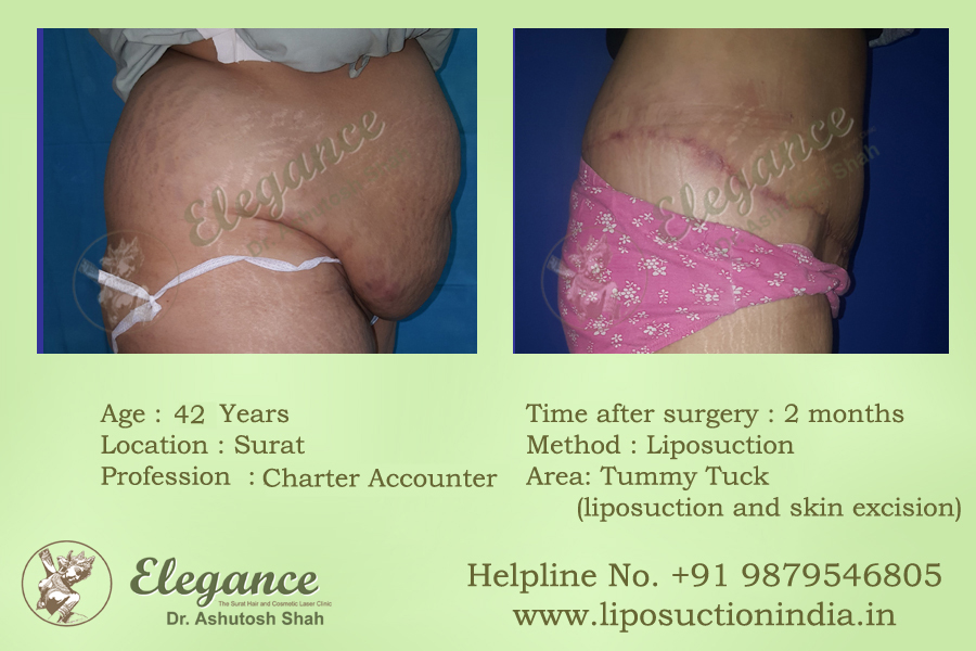 Surat, Gujarat, india Liposuction Clinic
