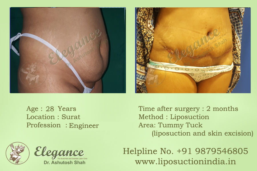 Best Liposuction Doctor in Surat, Gujarat, india