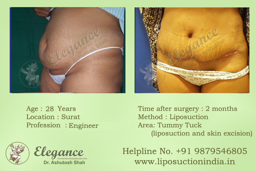 Liposuction Clinic in Surat, Gujarat, india