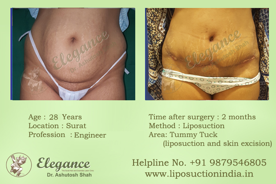 Liposuction in Surat Price