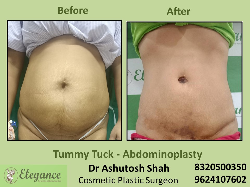 Tummy Tuck, Abdominoplasty Treatment in Vesu, Athwagate, Surat