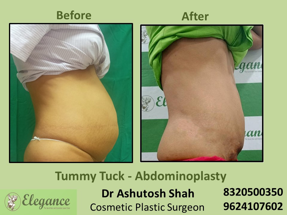 Tummy Tuck, Abdominoplasty Treatment in Athwagate, Surat