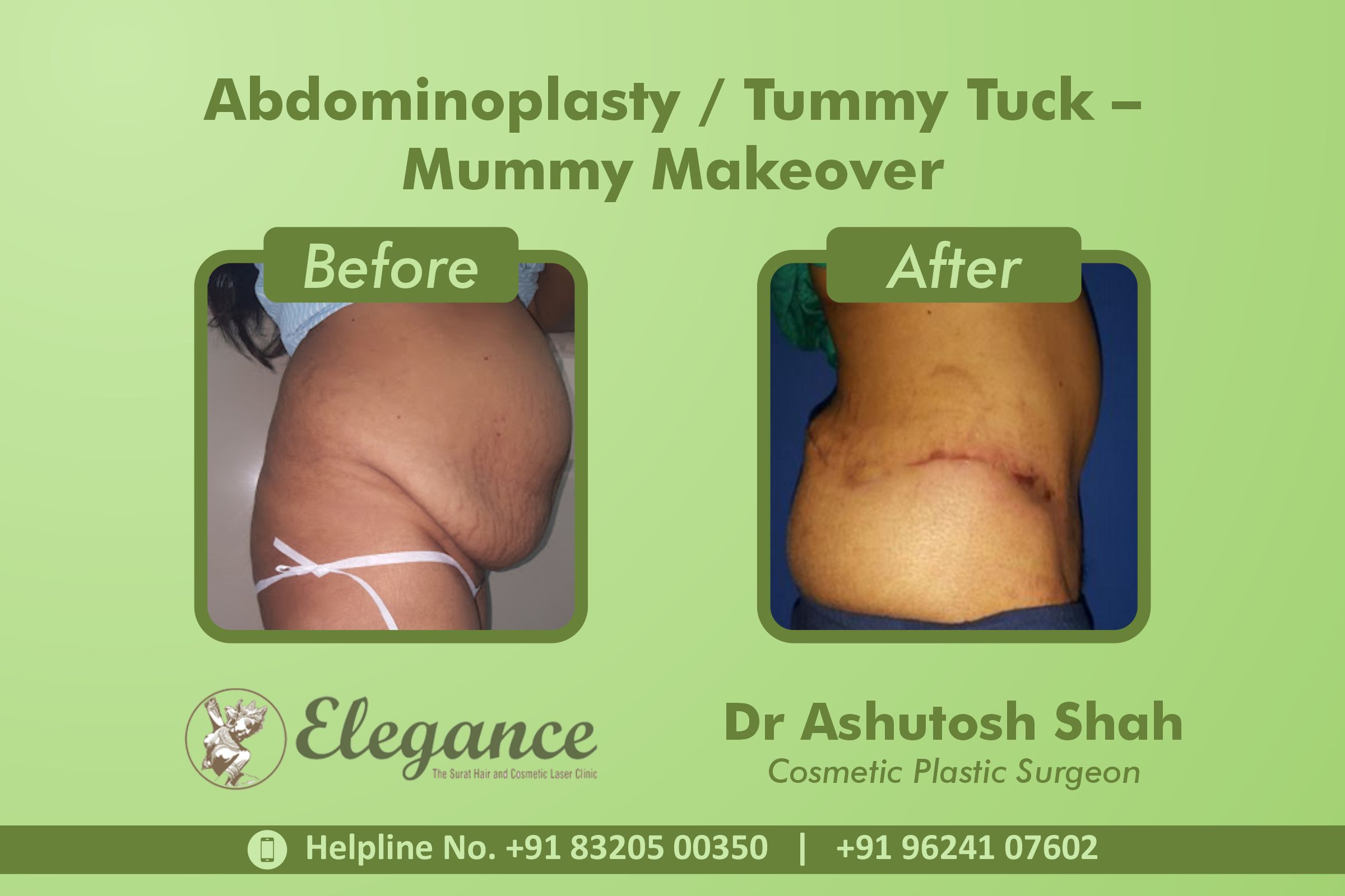 Tummy Tuck, Abdominoplasty Treatment in Vesu, Surat