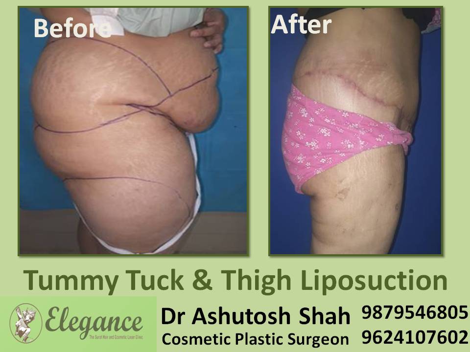 Tummy Tuck And Thigh Liposuction Result In Surat, Gujarat, India
