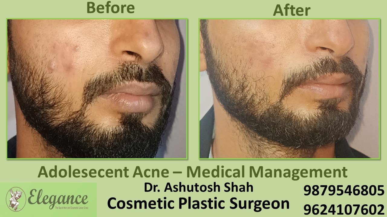 Low Cost Acne removal In Surat, Valsad, Vapi.