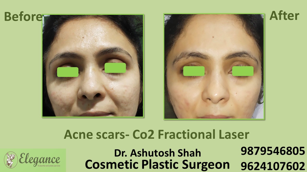 Low Cost Treatment For Acne And Pigmentation In Katargam, Vesu, Piplod, Surat