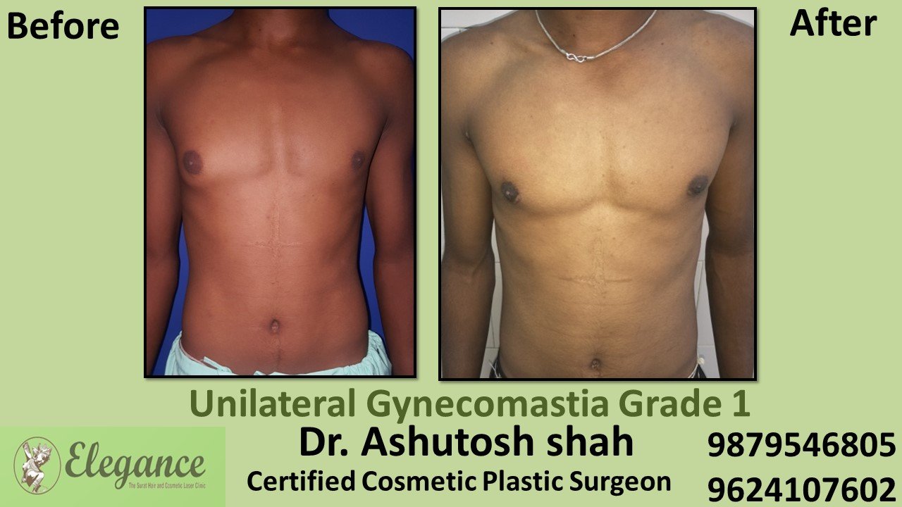 Type 1 Gynecomastia - Puffy Nipples in Surat