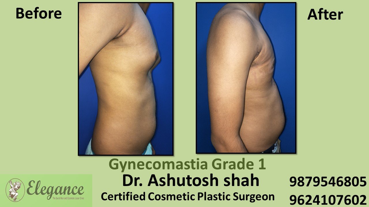 Type 1 Gynecomastia - Puffy Nipples in Surat