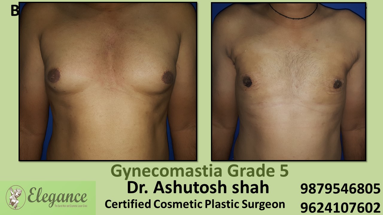Male Breast Reduction Surgery in Valsad, Gujarat