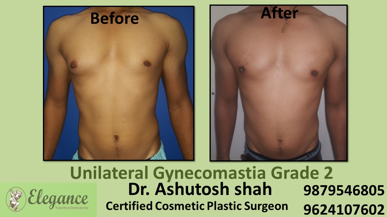 Male Breast Reduction Surgery, Kim, Gujarat