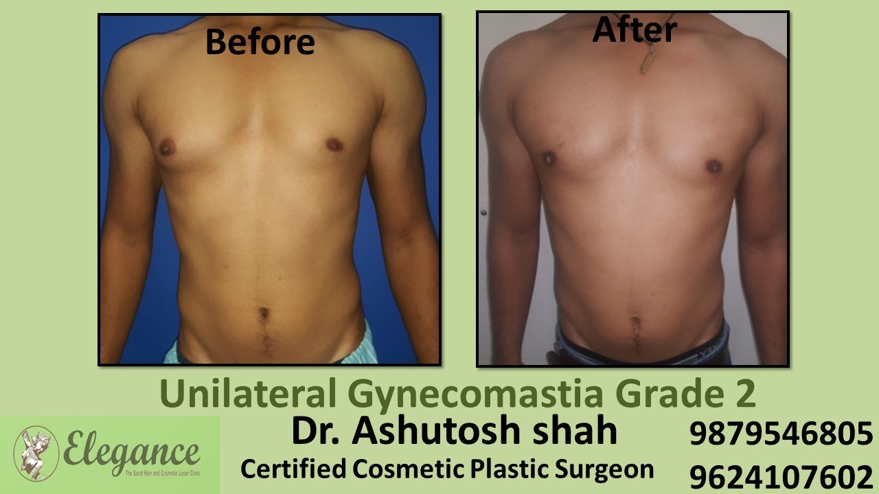 Male Breast Reduction Surgery, Kim, Gujarat