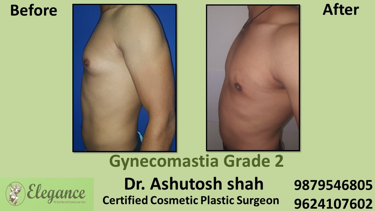 Male Breast Reduction Surgery, Kosamba, Gujarat