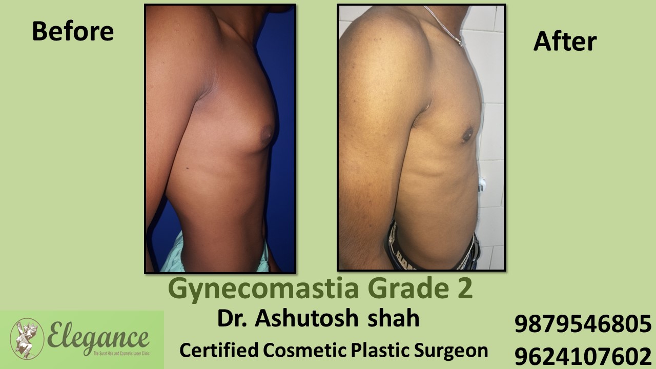 Male Breast Reduction Surgery, Sivassaa, Gujarat