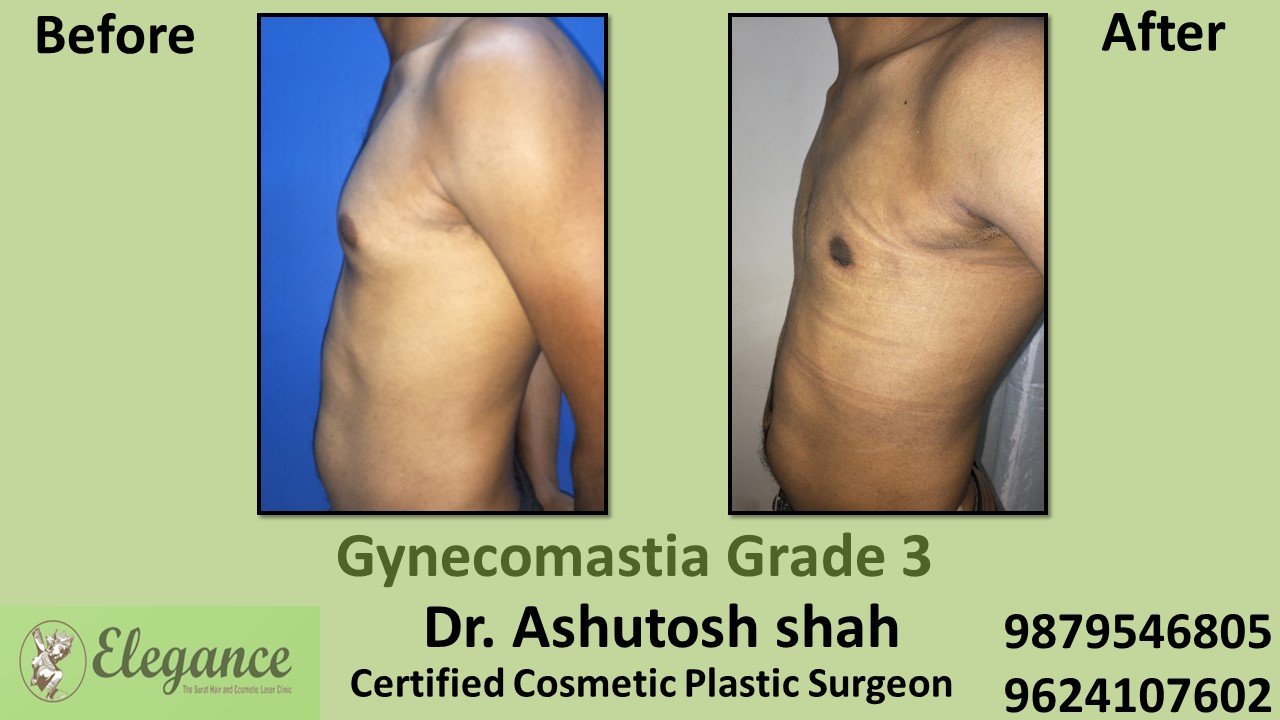 Male Breast Reduction Surgery, Valsad Gujarat