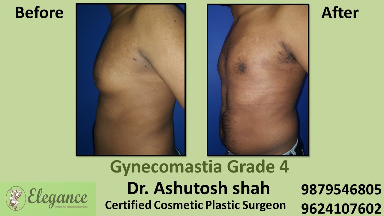 Male Large Breast Surgery Results in Ankleshwar, Gujarat